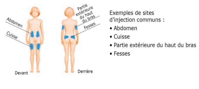 Image d’un enfant/adolescent avec des zones bleues montrant les sites d’injection communs sur l’abdomen, la cuisse, la partie extérieure du haut du bras et les fesses