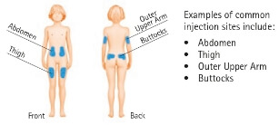 Image of child/youth with blue patches to show common injection sites of abdomen, thigh, outer upper arm, and buttocks